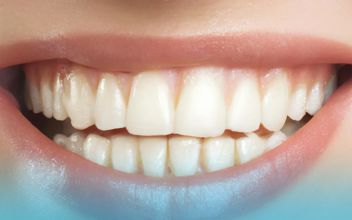 ferrule dentali e riposo notturno