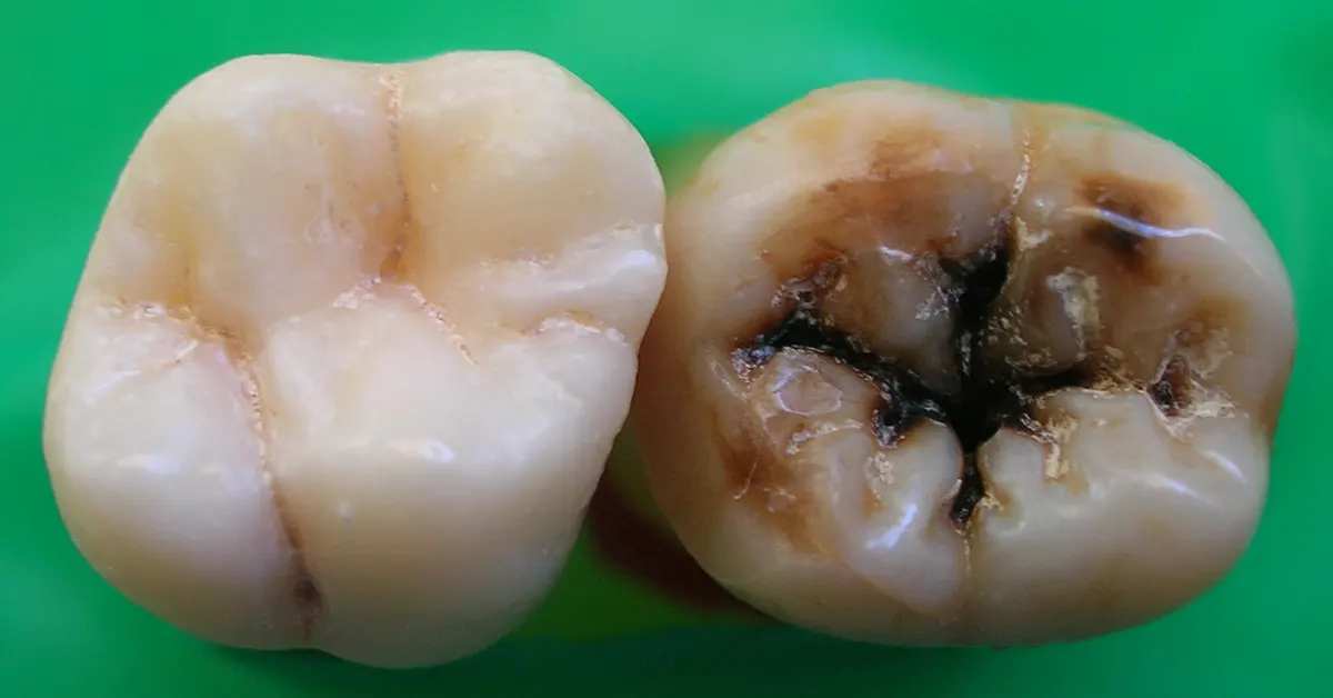 endodoncia profonda carie