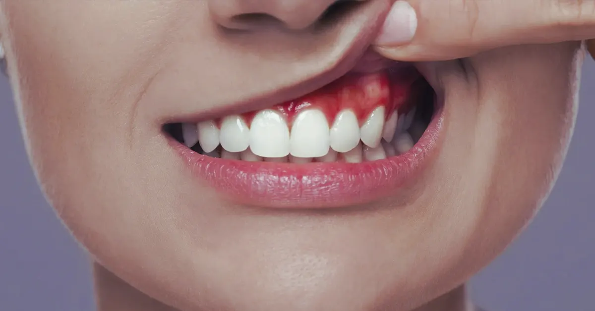 aftas in salute dentale infantile