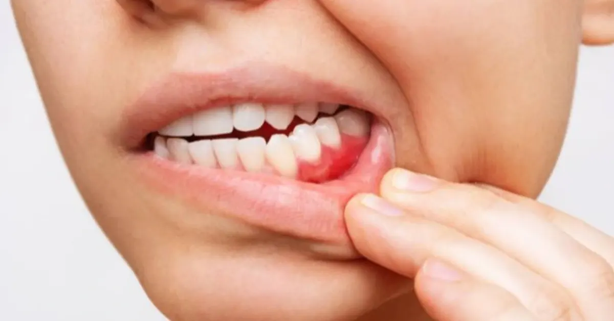 caries dentale nei bambini