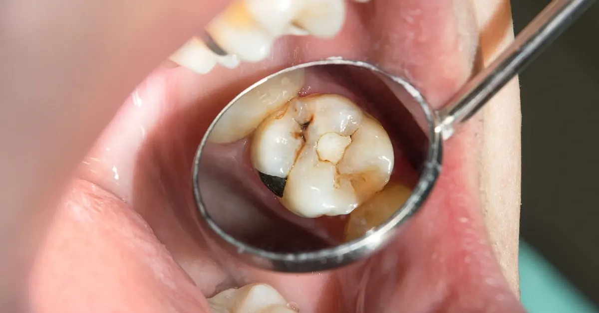 differenze carie sensibilità dentale