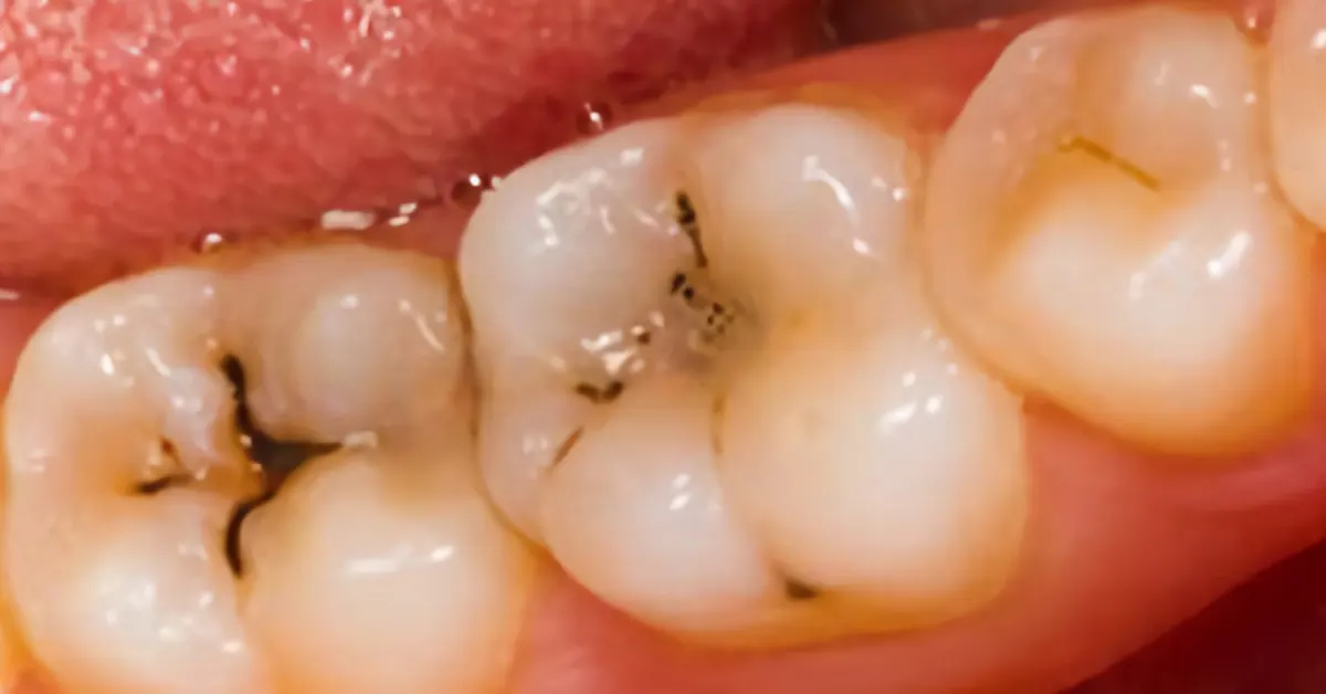 caries in avanti senza dolore