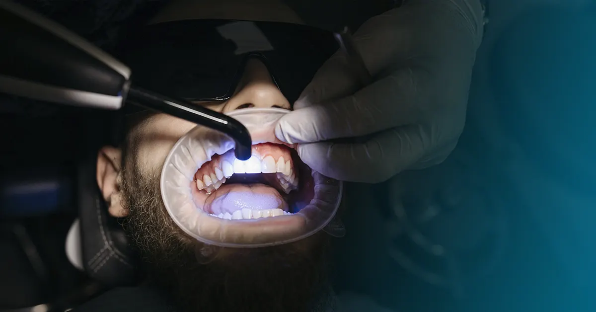 curare carie senza dentista