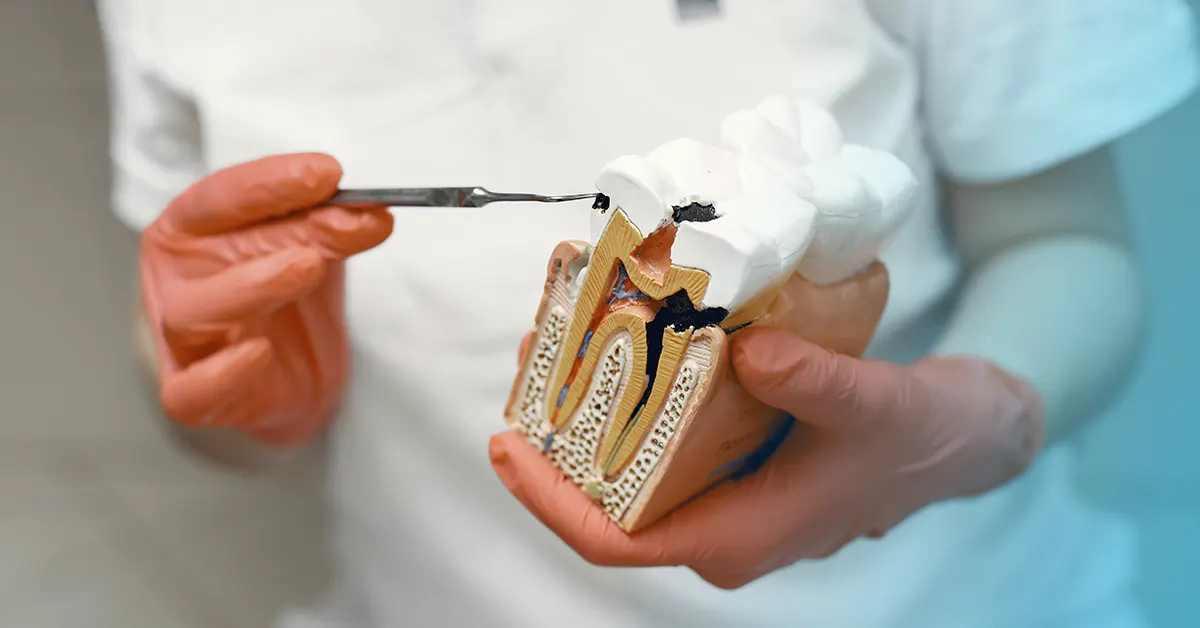 dentifrici sbiancanti e carie