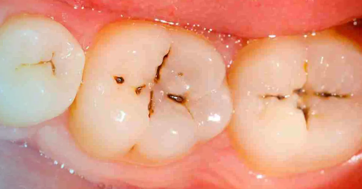 in cella perché ho le carie se mi spazzolo i denti