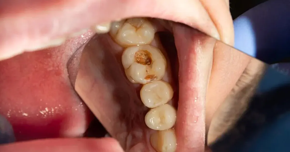 tempo dentista carie