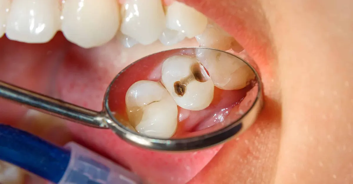 rimedi naturali dolore denti carie