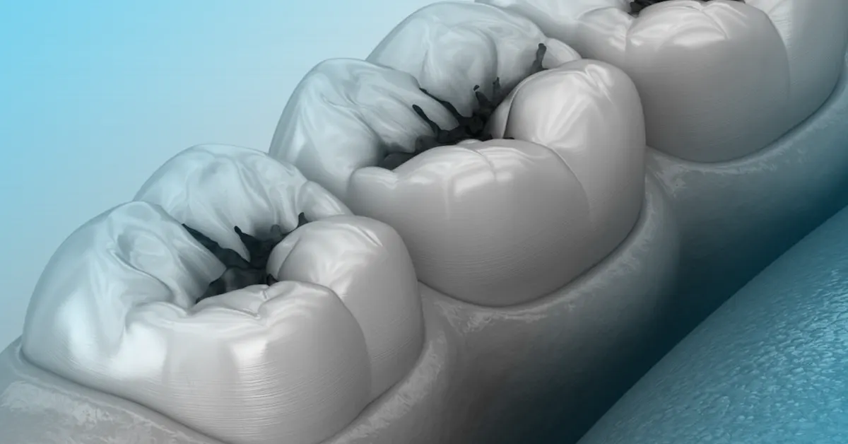 caries senza zucchero